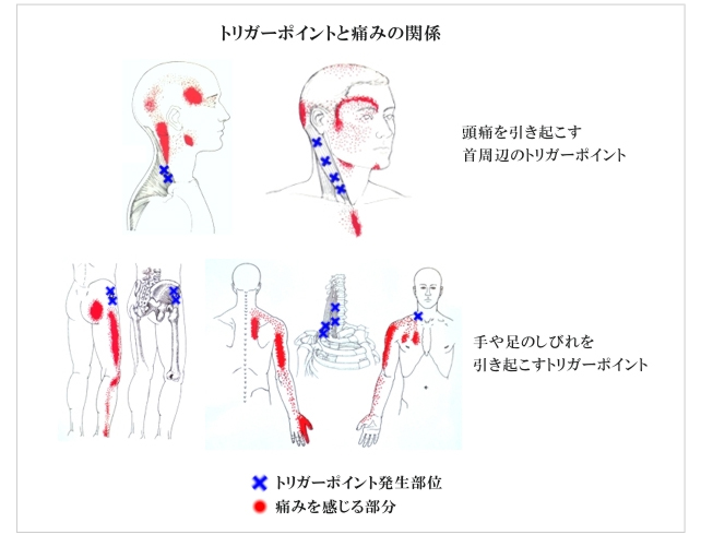 トリガーポイントと痛みの関係